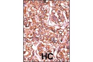 Formalin-fixed and paraffin-embedded human cancer tissue reacted with the primary antibody, which was peroxidase-conjugated to the secondary antibody, followed by AEC staining. (Retinoblastoma 1 抗体  (pSer612))