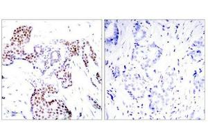 Immunohistochemical analysis of paraffin-embedded human breast carcinoma tissue using Elk1(Phospho-Ser389) Antibody(left) or the same antibody preincubated with blocking peptide(right). (ELK1 抗体  (pSer389))