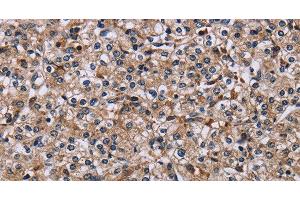 Immunohistochemistry of paraffin-embedded Human prostate cancer using IPO4 Polyclonal Antibody at dilution of 1:50 (Importin 4 抗体)