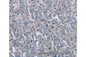 Immunohistochemistry of Human liver cancer using FAR2 Polyclonal Antibody at dilution of 1:50