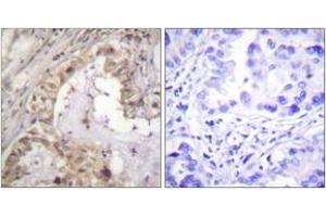 Immunohistochemistry analysis of paraffin-embedded human lung carcinoma tissue, using BCL-XL (Ab-47) Antibody. (BCL2L1 抗体  (AA 13-62))