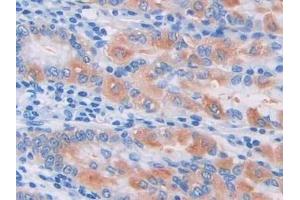 Detection of Pgp in Human Stomach cancer Tissue using Polyclonal Antibody to Permeability Glycoprotein (Pgp) (Permeability Glycoprotein 抗体  (AA 394-672))