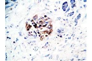 Human pancreas cancer tissue was stained by Rabbit Anti-GLP-1(7-36) -NH2 Antibody (GLP-1 抗体  (amidated))