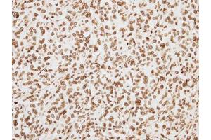 IHC-P Image Immunohistochemical analysis of paraffin-embedded TOV-21G xenograft, using ORC6L, antibody at 1:500 dilution. (ORC6 抗体  (C-Term))
