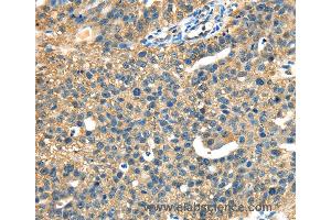 Immunohistochemistry of Human ovarian cancer using DHCR24 Polyclonal Antibody at dilution of 1:40 (Seladin 1 抗体)