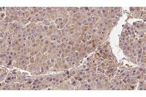 ABIN6273354 at 1/100 staining Human liver cancer tissue by IHC-P. (DIRAS3 抗体  (C-Term))