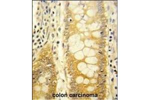 Formalin-fixed and paraffin-embedded human colon carcinoma reacted with LGALS2 Antibody (Center), which was peroxidase-conjugated to the secondary antibody, followed by DAB staining. (Galectin 2 抗体  (AA 85-111))
