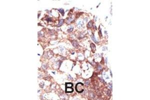 Formalin-fixed and paraffin-embedded human cancer tissue reacted with the primary antibody, which was peroxidase-conjugated to the secondary antibody, followed by DAB staining. (Ubiquilin 1 抗体  (N-Term))