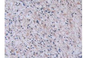 Detection of TPS in Human Glioma Tissue using Monoclonal Antibody to Tryptase (TPS) (TPSAB1 抗体  (AA 161-262))
