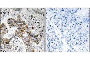 Immunohistochemistry analysis of paraffin-embedded human breast carcinoma tissue, using KCNK15 Antibody. (KCNK15 抗体  (AA 273-322))