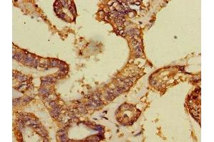 Immunohistochemistry of paraffin-embedded human endometrial cancer using ABIN7149526 at dilution of 1:100 (DCAF8 抗体  (AA 1-135))