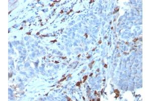 Formalin-fixed, paraffin-embedded human Tumor stained with IgM Recombinant Rabbit Monoclonal Antibody (IGHM/3135R). (Recombinant IGHM 抗体)
