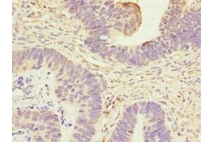 Immunohistochemistry of paraffin-embedded human ovarian cancer using ABIN7144326 at dilution of 1:100 (ANTXR2 抗体  (AA 340-489))