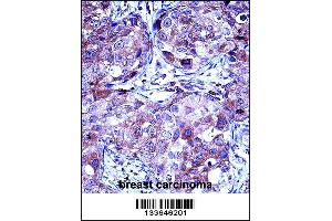 MMP13 Antibody immunohistochemistry analysis in formalin fixed and paraffin embedded human breast carcinoma followed by peroxidase conjugation of the secondary antibody and DAB staining.
