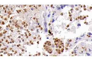 Detection of CASP3 in Human Lung cancer Tissue using Monoclonal Antibody to Caspase 3 (CASP3) (Caspase 3 抗体  (AA 29-175))