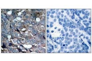 Immunohistochemical analysis of paraffin-embedded human breast carcinoma tissue using ASK1 (phospho-Ser83) antibody (E011178). (ASK1 抗体  (pSer83))