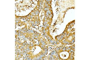 Immunohistochemistry (IHC) image for anti-Carcinoembryonic Antigen-Related Cell Adhesion Molecule 5 (CEACAM5) antibody (ABIN7266084)