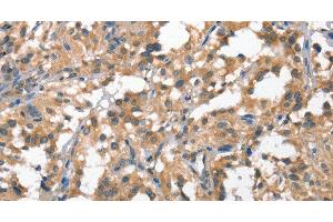 Immunohistochemistry of paraffin-embedded Human thyroid cancer tissue using HGF Polyclonal Antibody at dilution 1:65 (HGF 抗体)