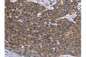 The image on the left is immunohistochemistry of paraffin-embedded Human cervical cancer tissue using ABIN7192846(TNPO1 Antibody) at dilution 1/25, on the right is treated with synthetic peptide. (Transportin 1 抗体)