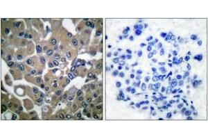 Immunohistochemistry analysis of paraffin-embedded human breast carcinoma, using PLCG1 (Phospho-Tyr783) Antibody. (Phospholipase C gamma 1 抗体  (pTyr783))