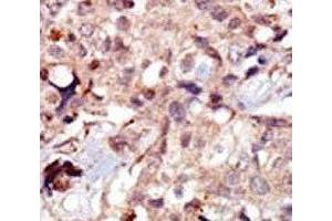 IHC analysis of FFPE human breast carcinoma tissue stained with the MLCK antibody (MYLK 抗体  (AA 908-938))