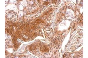 IHC-P Image TPK1 antibody detects TPK1 protein at cytosol on Cal27 xenograft by immunohistochemical analysis. (TPK1 抗体)