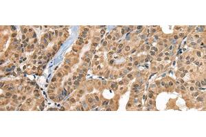 Immunohistochemistry of paraffin-embedded Human thyroid cancer tissue using RTCB Polyclonal Antibody at dilution of 1:30(x200) (C22orf28 抗体)
