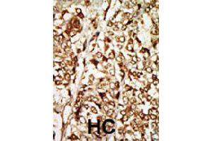 Formalin-fixed and paraffin-embedded human hepatocellular carcinoma tissue reacted with MOS polyclonal antibody  , which was peroxidase-conjugated to the secondary antibody, followed by AEC staining. (MOS 抗体  (N-Term))