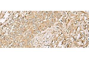 Immunohistochemistry of paraffin-embedded Human ovarian cancer tissue using QDPR Polyclonal Antibody at dilution of 1:70(x200) (QDPR 抗体)