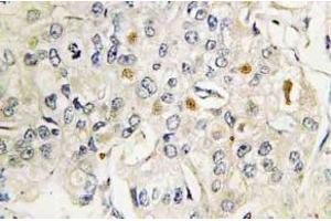 Immunohistochemistry (IHC) analyzes of VDR antibody in paraffin-embedded human breast carcinoma tissue. (Vitamin D Receptor 抗体)
