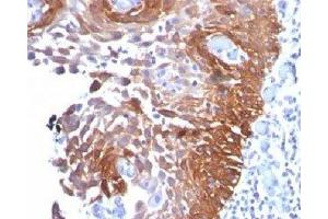 IHC testing of cervical carcinoma stained with Cytokeratin 17 antibody. (KRT17 抗体)