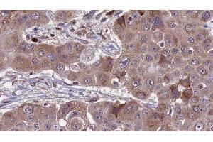 ABIN6276476 at 1/100 staining Human liver cancer tissue by IHC-P. (RHOC 抗体  (C-Term))