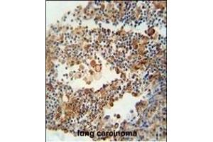 OR9Q1 antibody (C-term) (ABIN654850 and ABIN2844515) immunohistochemistry analysis in formalin fixed and paraffin embedded human lung carcinoma followed by peroxidase conjugation of the secondary antibody and DAB staining. (OR9Q1 抗体  (C-Term))