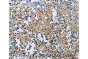 Immunohistochemistry of Human gastric cancer using BMPR1B Polyclonal Antibody at dilution of 1:30 (BMPR1B 抗体)