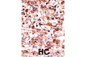 Formalin-fixed and paraffin-embedded human cancer tissue reacted with the primary antibody, which was peroxidase-conjugated to the secondary antibody, followed by AEC staining. (CDK1 抗体  (pSer39))