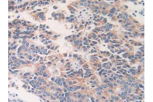 IHC-P analysis of Human Prostate Cancer Tissue, with DAB staining. (ETFB 抗体  (AA 2-255))