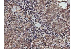 Immunohistochemical staining of paraffin-embedded Adenocarcinoma of Human breast tissue using anti-AKT1 mouse monoclonal antibody. (AKT1 抗体)