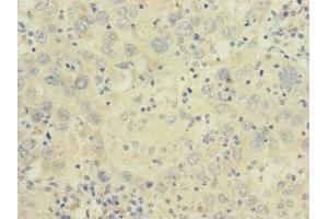 Immunohistochemistry of paraffin-embedded human liver cancer using ABIN7175581 at dilution of 1:100 (CACNA2D2 抗体  (AA 20-200))