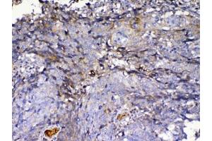 IHC testing of FFPE human lung cancer tissue with IGFBP2 antibody at 1ug/ml. (IGFBP2 抗体)