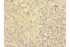 Immunohistochemistry of paraffin-embedded human liver cancer using ABIN7149008 at dilution of 1:100 (CSRP2 抗体  (AA 1-193))