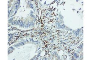 IHC-P: EIF6 antibody testing of human intestine cancer tissue (EIF6 抗体  (Middle Region))