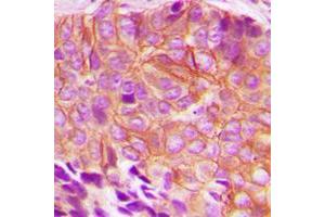 Immunohistochemical analysis of BIK (pT33) staining in human breast cancer formalin fixed paraffin embedded tissue section. (BIK 抗体  (N-Term, pSer33))