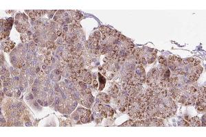 ABIN6273288 at 1/100 staining Human pancreas cancer tissue by IHC-P. (PCCA 抗体  (C-Term))