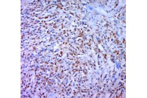 Paraformaldehyde-fixed, paraffin embedded human gastric carcinoma; Antigen retrieval by boiling in sodium citrate buffer (pH6. (DAXX 抗体  (pSer668))