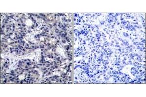 Immunohistochemistry analysis of paraffin-embedded human breast carcinoma tissue, using PKR (Ab-446) Antibody. (EIF2AK2 抗体  (AA 413-462))