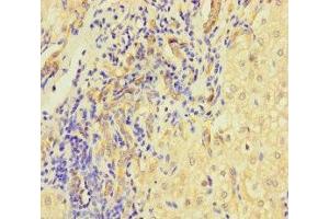 Immunohistochemistry of paraffin-embedded human liver cancer using ABIN7158401 at dilution of 1:100 (L1TD1 抗体  (AA 665-865))