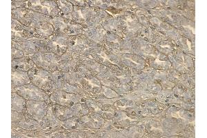 ABIN6264465 and ABIN6272654 at 1/100 staining human renal cell carcinoma by IHC-P.