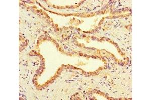Immunohistochemistry of paraffin-embedded human prostate cancer using ABIN7168168 at dilution of 1:100 (RIOX2 抗体  (AA 1-300))