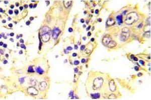 Immunohistochemistry (IHC) analyzes of SRC antibody in paraffin-embedded human breast carcinoma tissue. (NCOA1 抗体)