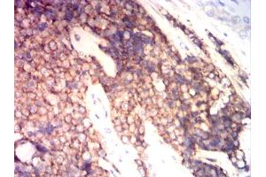 Immunohistochemical analysis of paraffin-embedded ewing sarcoma tissues using CD99 mouse mAb with DAB staining. (CD99 抗体  (AA 1-185))